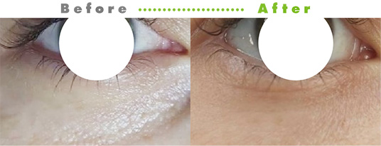 プルリアルシルク症例2