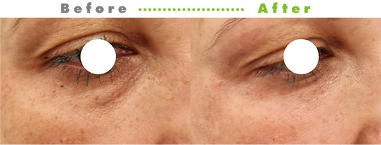 プルリアルシルク症例3